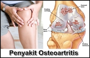 Obat Osteoartritis Herbal
